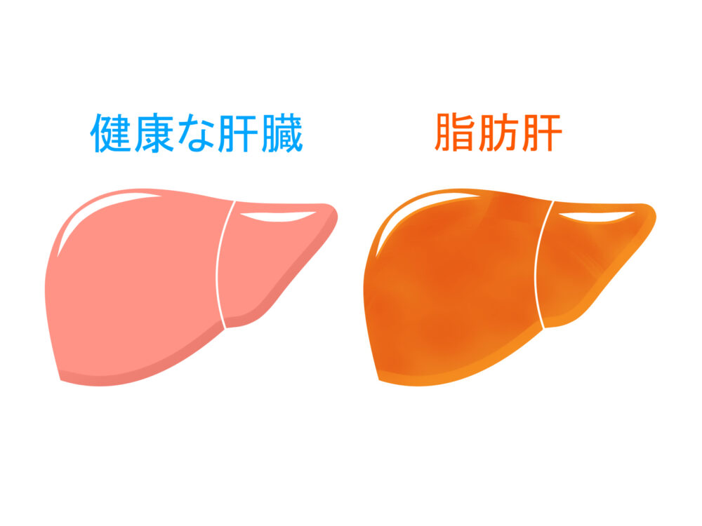脂肪肝