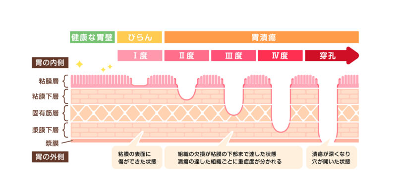 胃がん